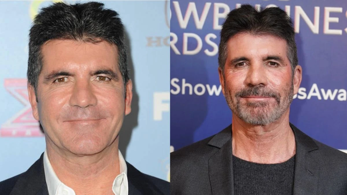 Simon Cowell Plastic Surgery, Simon Cowell Before And After Plastic Surgery